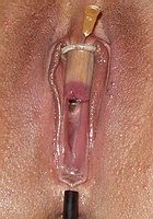 Nål i klitoris